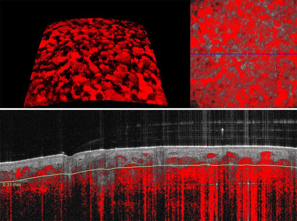 Proliferative Vascular Lesions VivoSight