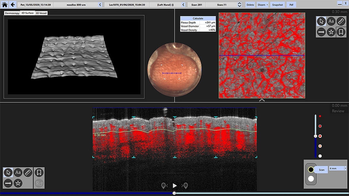 VivoSight Dynamic OCT (D-OCT) screen image showing camera view, enface scan and 3-D rendering of skin surface