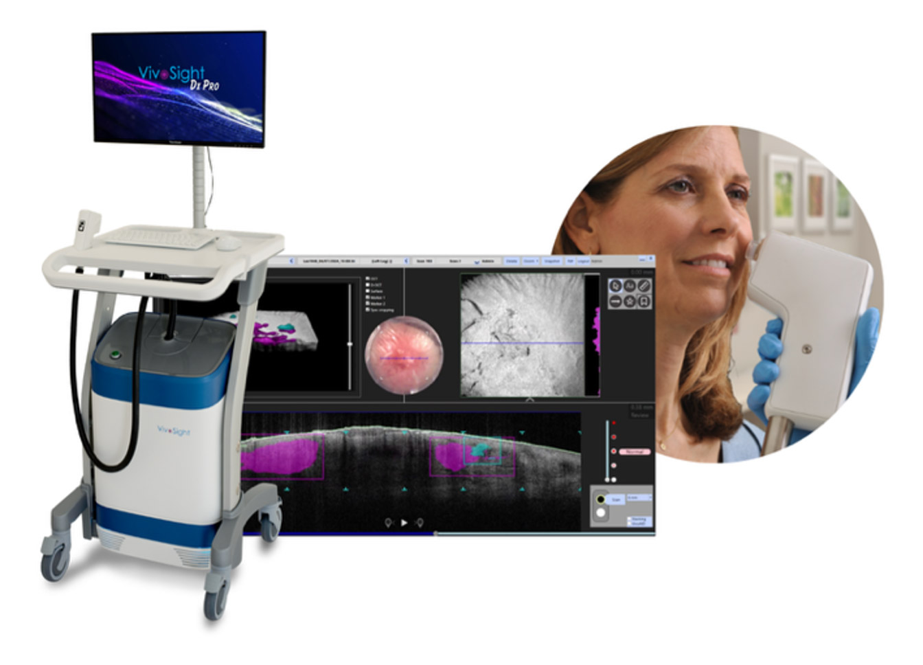 VivoSight Dx Pro OCT skin imaging system, patient being scanned and OCT imaging displayed on screen