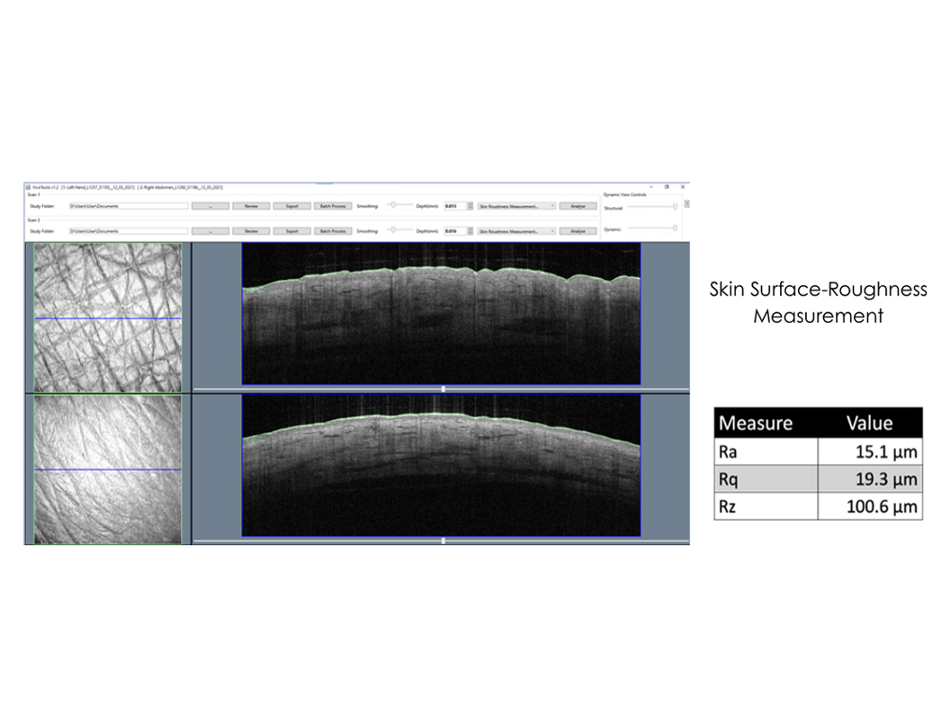 Skin surface roughness measurement