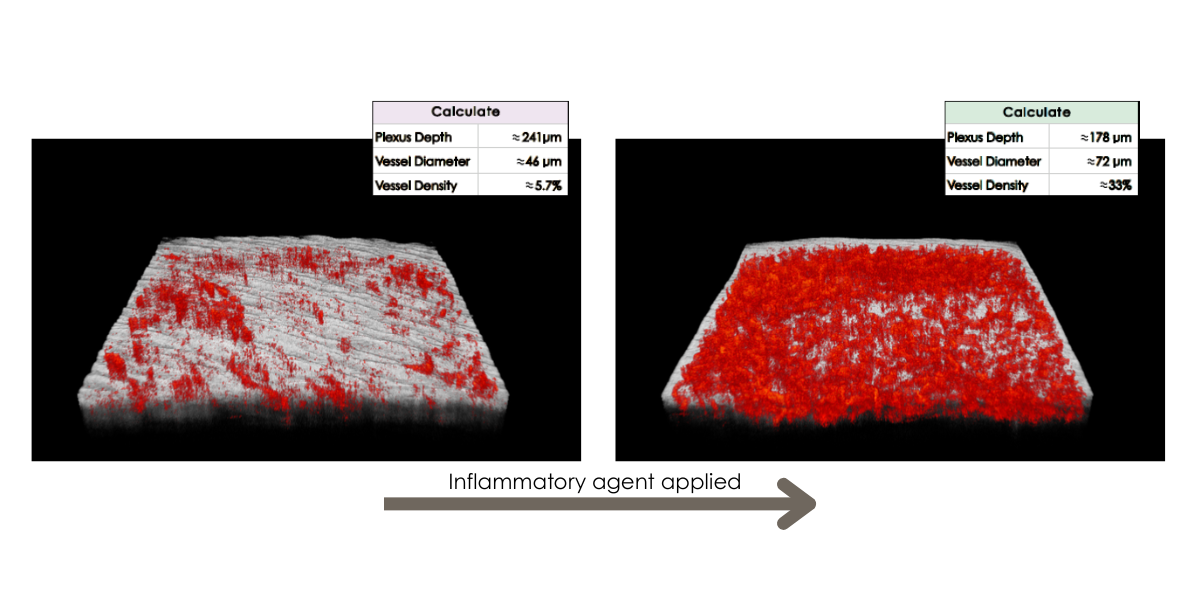 D-OCT scans showing the effect of an inflammatory agent on skin microvasculature