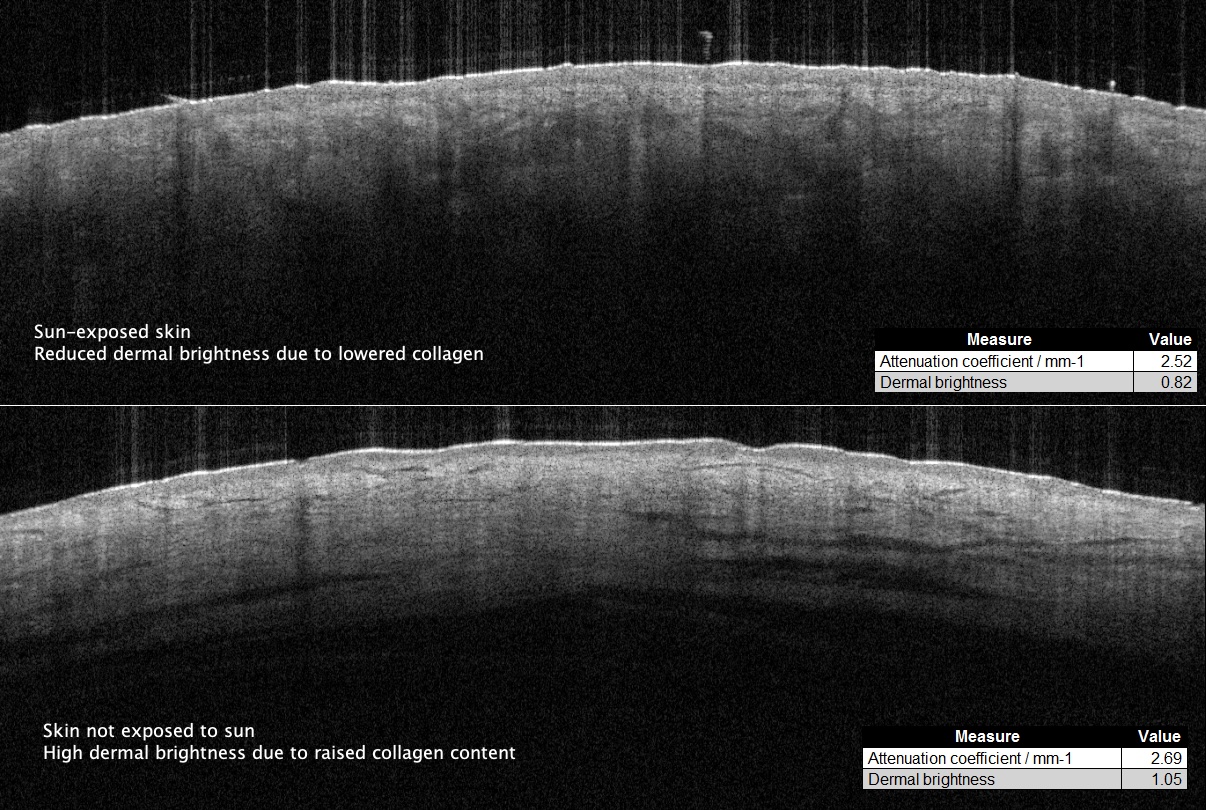 OCT dermal brightness measurement on sun exposed skin